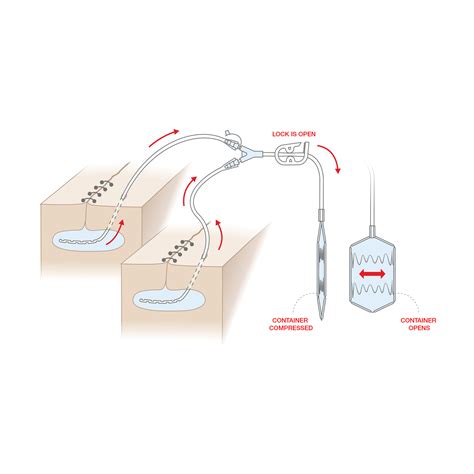 Flat Wound Drainage Reservoir Spring Vac