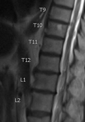 Figure T10 Hemangioma Contibuted By Drdawood Tafti Statpearls