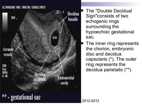 Vaginal Bleeding In Early Pregnancy