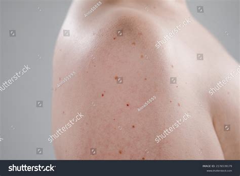 Close Large Moles On Naked Female Stock Photo 2176539179 Shutterstock