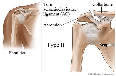 Type II shoulder separation | Healthing.ca