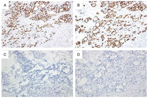 Primary Anastomosing Hemangioma As A Preoperative Diagnostic Mimicker