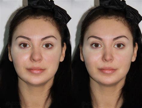 Ринопластика картошка