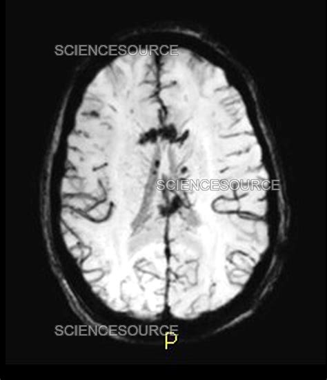 Severe Traumatic Brain Injury, MRI | Stock Image - Science Source Images