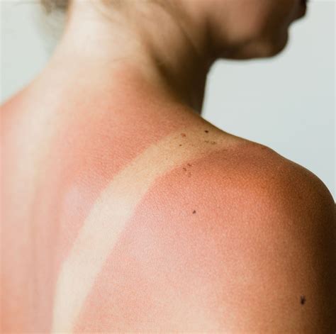 Top 10 Effective Sunburn Treatments For Rapid Skin Soothing And Healing