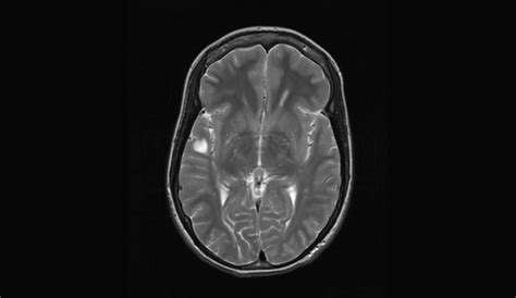 Hope - Victory over Multiple Sclerosis : MRI Lesions Gone