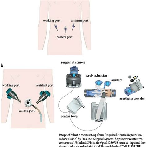 Experimental Setup A Laparoscopic Transabdominal Preperitoneal Tapp Download Scientific