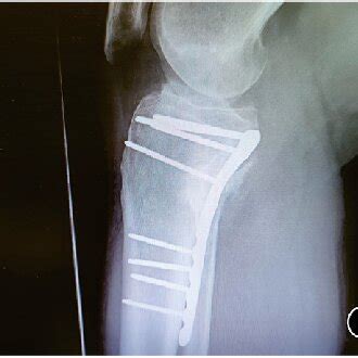 Preoperative A And Postoperative B Images Of A Posteromedial Tibial