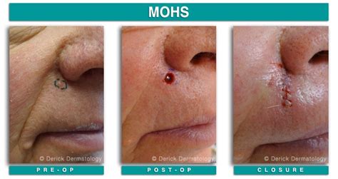 Mohs Micrographic Surgery To Treat Basal Cell Carcinoma On The Upper Lip Carcinoma Mohs