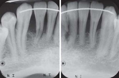 Anterior Periapical Radiograph