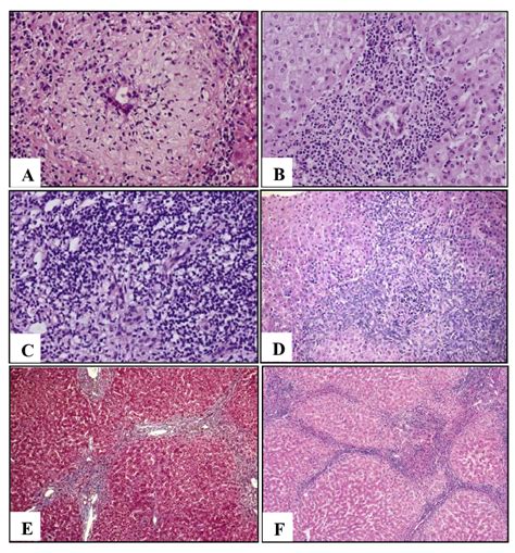 Pbc Stage According To Scheuer A Florid Duct Lesions B And C Download Scientific Diagram