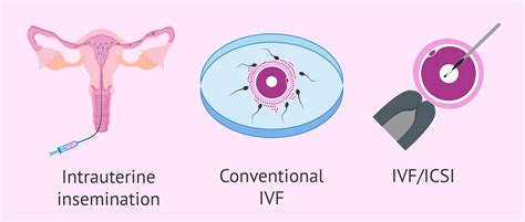 In Vitro Fertilization Ivf What Is It And How Much Does 57 Off