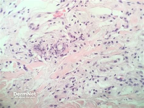 Eruptive Xanthoma Pathology