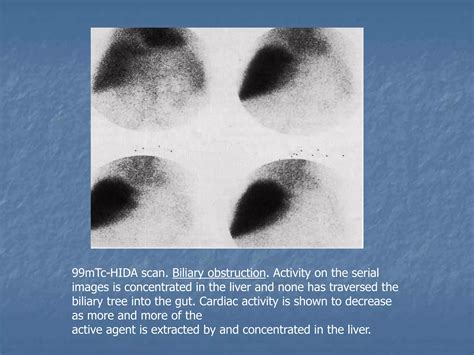 Biliary tract | PPT