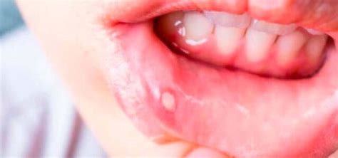 Herpes Labial ¿qué Son Y Cómo Se Curan Las Calenturas Labiales