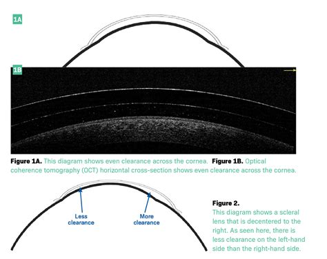 Use Oct To Determine Scleral Lens Clearance