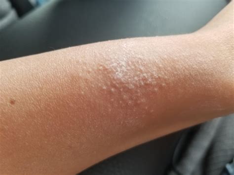 Little White Itchy Bumps On Skin