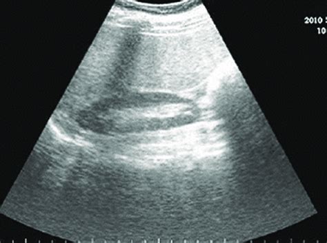 ultrasound scan showing increased echotexture of the liver in... | Download Scientific Diagram