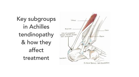 Key Subgroups In Achilles Tendinopathy And How They Affect Treatment Runningphysio