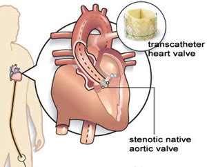 Heart valve replacement without open-heart surgery is subject of ...