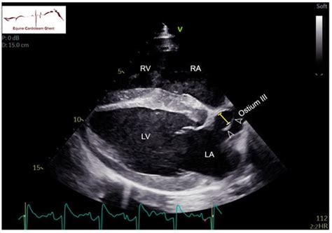 Echocardiographic Features Of The Ductus Arteriosus And The Foramen