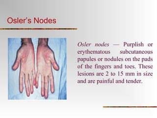Endocarditis Ppt