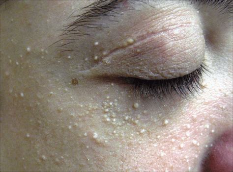 что такое милиум на лице