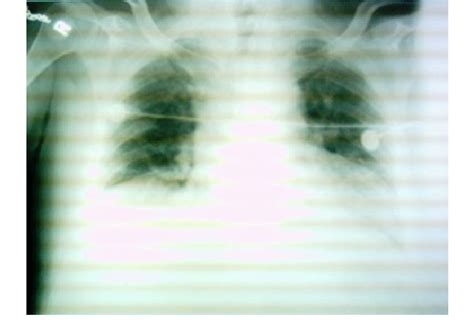 Patient S Chest X Ray Showing Atelectasis And Bilateral Infiltration