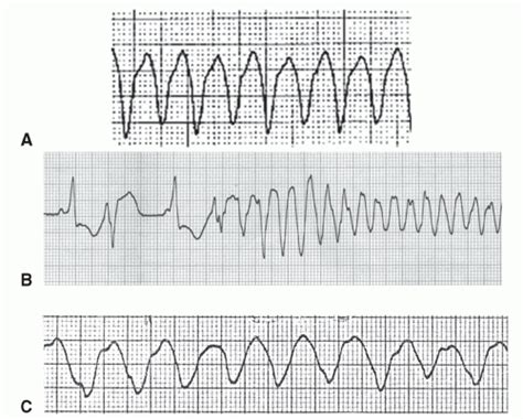 Monomorphic Vs Polymorphic Ventricular Tachycardia