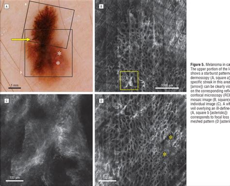 Figure 5 From Correlation Of Dermoscopic Structures Of Melanocytic