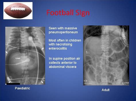 Abdominal Xray Radiological Signs Suzanne Ohagan Lightbulb Moment