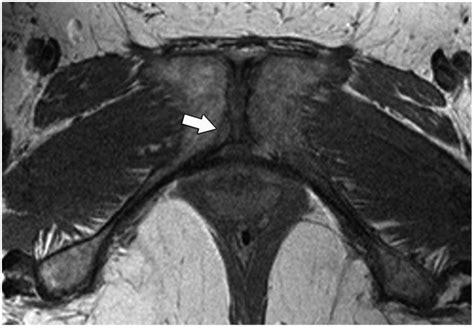 Pubic Bone Injuries In Primiparous Women Magnetic Resonance Imaging In