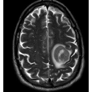 MRI of the brain showed a large mass in the left frontal area T2/FLAIR ...