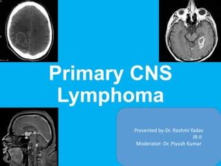 Primary Cns Lymphoma Ppt