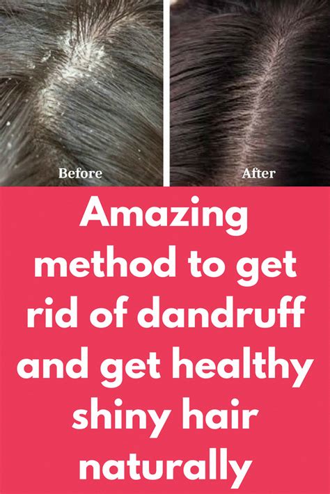 Amazing Method To Get Rid Of Dandruff And Get Healthy Shiny Hair