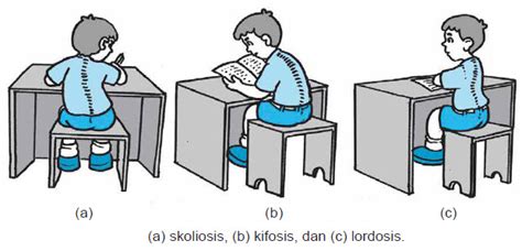 Gambar Kelainan Tulang Skoliosis Lordosis Dan Kifosis Ruang Ilmu