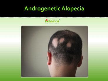 PPT – Androgenetic Alopecia Causes, Symptoms, Diagnosis, Risk factor ...