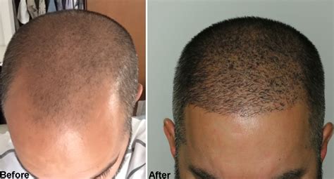 Body Hair Transplant Result Bht Alvi Armani Hair Transplant Los Angeles