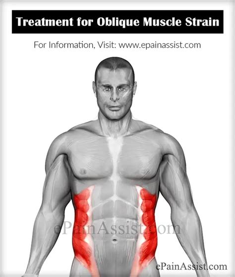 Oblique Muscle Strain|Causes|Symptoms|Treatment|Recovery