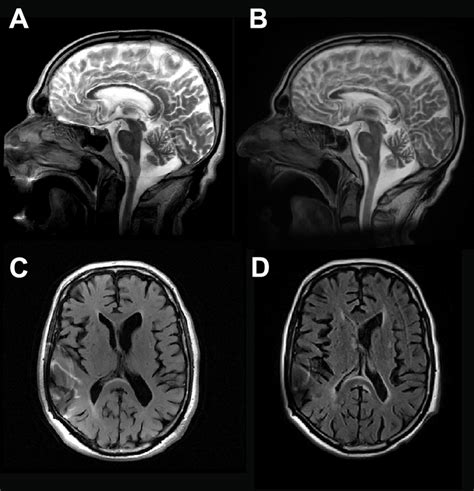 Baseline MRI (A, C: 1.5T-GE_Medical-System-Signa-Excite) and 3-weeks... | Download Scientific ...