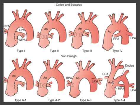 Truncus Arteriosus Pediatric Echocardiography