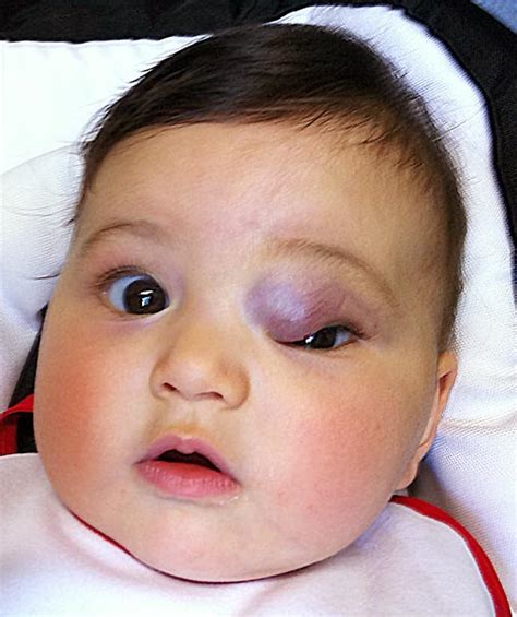 Compva Infantile Hemangioma Eye And Orbit In An Infant