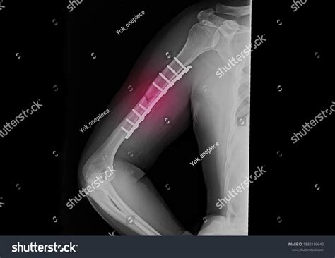 47 Radial Humerus Joint Images, Stock Photos & Vectors | Shutterstock