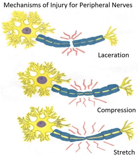 Classification of Peripheral Nerve Injury - Physiopedia