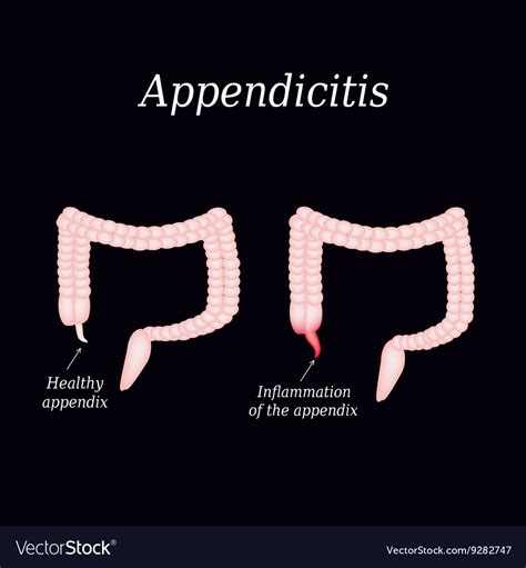 Appendicitis Inflammation Of The Appendix Colon Vector Image