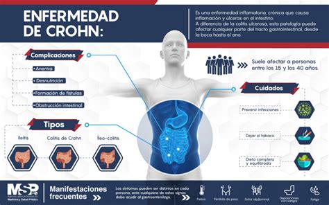 Enfermedad De Crohn Y Dispositivos M Dicos Dispositivos M Dicos