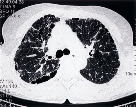 Idiopathic Pulmonary Fibrosis Acute Hypersensitivity Pneumonitis