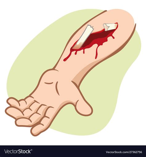 Arm Wich Compound Fracture Showing Broken Bone Vector Image