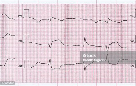 Ekg Dengan Infark Miokard Makrofokal Dan Ketukan Prematur Ventrikel Foto Stok Unduh Gambar