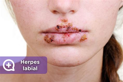 Sin sentido núcleo global herpes labial tipos número caos doble